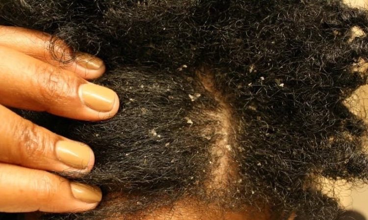 How to Cure Dandruff Permanently With This Little Natural Supplement Only
